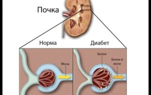 Почки при сахарном диабете 1 типа