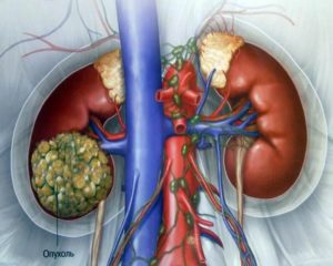 Можно ли вылечить опухоль почки без операции