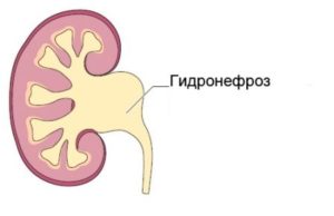 Расширение лоханки почки у новорожденного операция