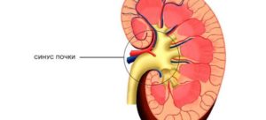 Расщепление синусов почек