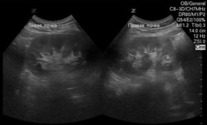 Воспаление почек можно ли увидеть на узи