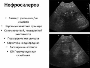 Нефросклероз почек на узи