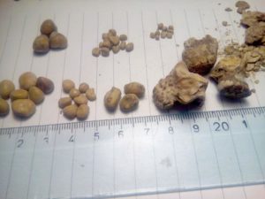 Размеры камней и песка в почках