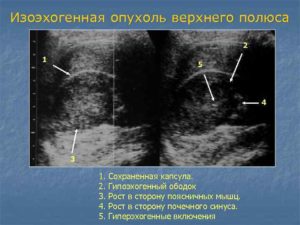 Изоэхогенное образование в почке