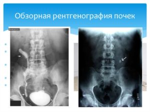 Обзорная рентгенография это