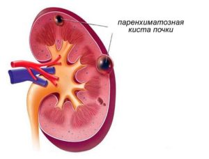 Мелкая киста паренхимы почки