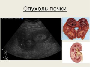 Капсульная опухоль почки