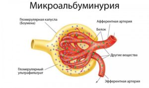 Микроальбуминурия что это