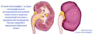 Острый пиелонефрит слева