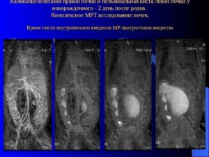 Каликопиелоэктазия левой почки что это такое лечение