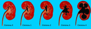 Каликоэктазия почек причины