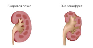 Пиелонефрит почек у детей что это такое