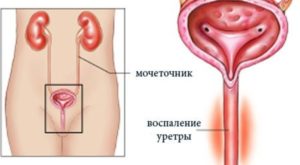 Покалывание в мочеиспускательном канале у женщин