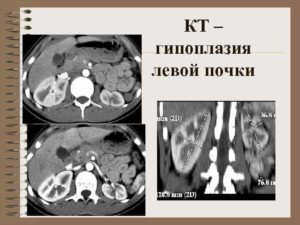 Что такое гипоплазия почки у взрослого человека