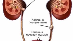 Камень вышел из почки и застрял в мочевом пузыре