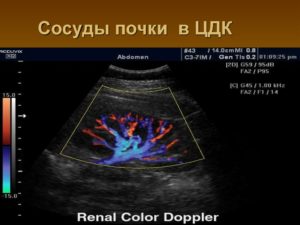 Как проверить сосуды в почках