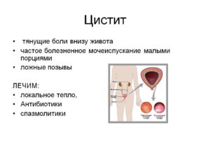 Боли внизу живота после цистита