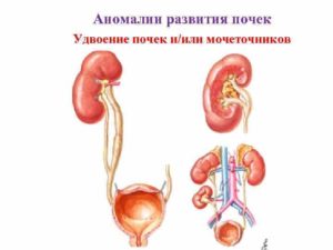 Удвоение почек и мочеточников