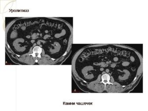 Конкременты чашечек левой почки