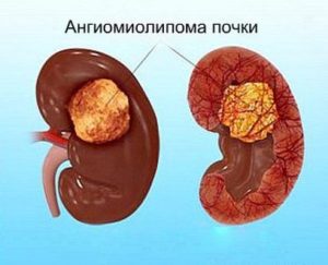 Новообразование в почке лечение народными средствами