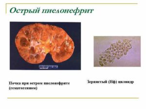 Зернистые цилиндры при пиелонефрите