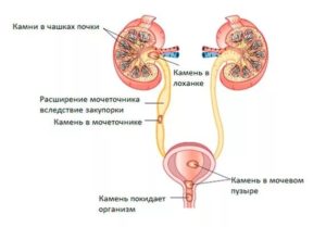 Камень идет по мочеточнику симптомы