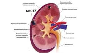 Паренхиматозная киста почек