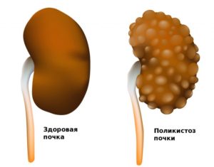 Поликистозная болезнь почек