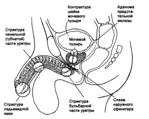 Зуд в уретре у мужчин