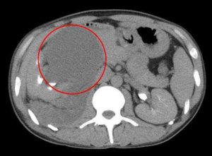 Киста на почке или рак