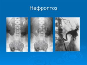 Поясничный нефроптоз справа