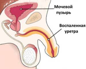 Ромашка при уретрите у мужчин