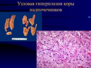 Гиперплазия коры надпочечников