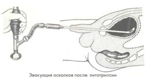 Камни в мочевом пузыре операция