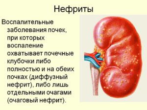 Нефрит симптомы и лечение у детей