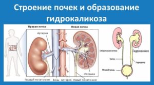 Гидрокаликоз почки у беременных