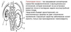 Гипоплазия правой почки мкб