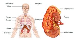 Метастазы почек рак
