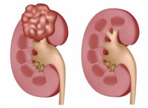 Опухоль в почках симптомы у женщин