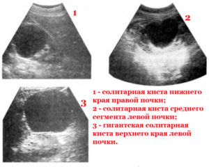 Киста левой в нижнем полюсе почки