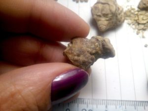 Камни в почках до 4 мм