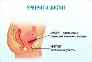 Рези в мочеиспускательном канале у женщин