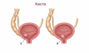 Киста мочевого пузыря симптомы у женщин