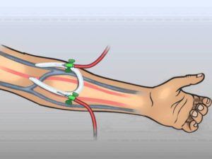 Фистула для гемодиализа