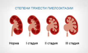 Пиелоэктазия почки плода справа