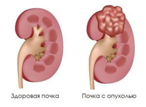 Как определить опухоль почек