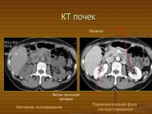 Чем отличается кт от мрт почек