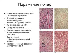 Миеломная болезнь почек