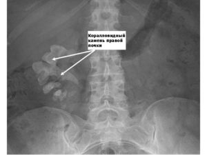 Узи показало камни в почках а рентген нет