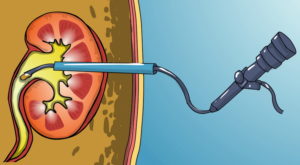 Удаление камня из протока почки